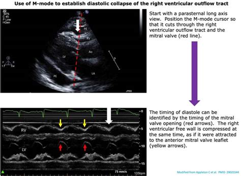 transient buckling of tamponade